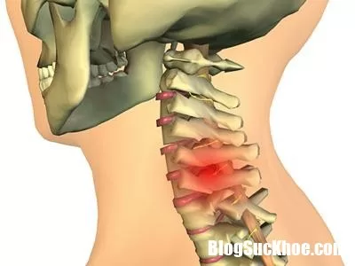 Ngày càng nhiều người bị thoái hóa đốt sống cổ, nguyên nhân do đâu ?
