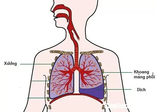 Những biến chứng và di chứng nguy hiểm của tràn dịch màn phổi