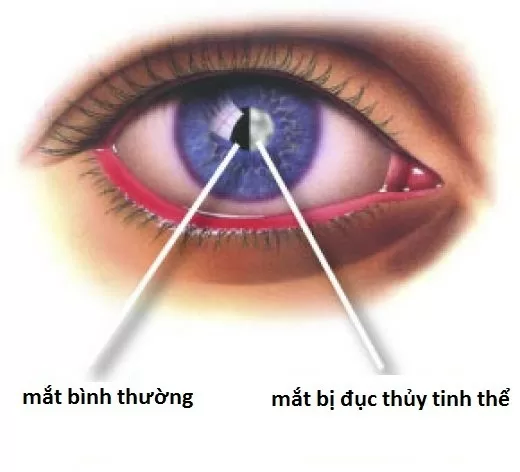 Người già và những căn bệnh về mắt nguy hiểm nhất