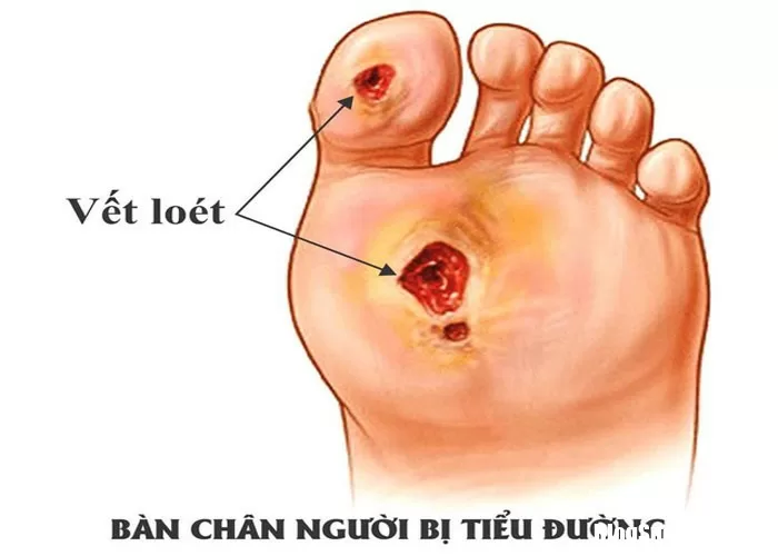 Những dấu hiệu báo trước của bệnh đái tháo đường