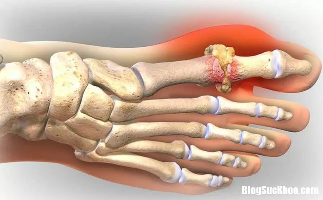Cách ăn uống, nghỉ ngơi và vận động giúp đẩy lùi bệnh Gout