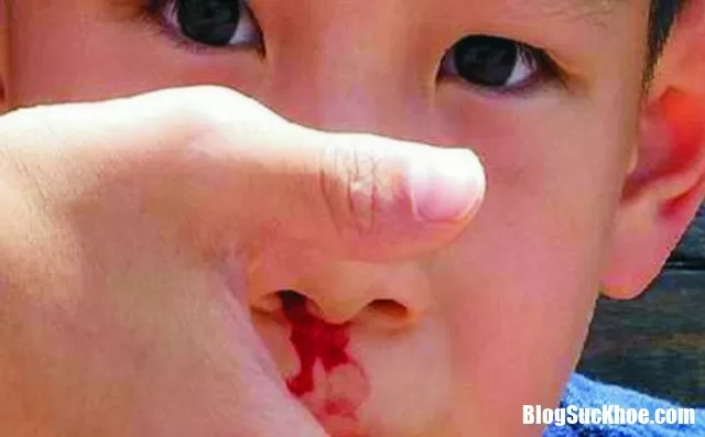 Cách xử trí và phòng ngừa chảy máu cam ở trẻ em