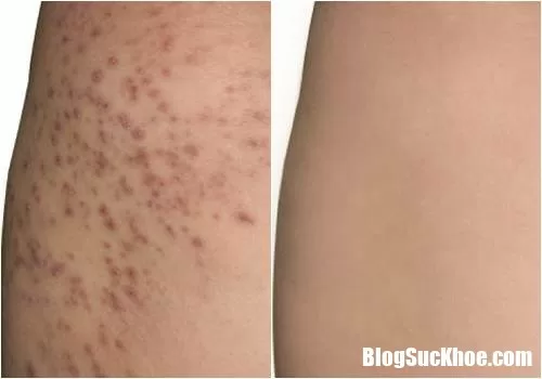 Bệnh viêm nang lông - Nguyên nhân và cách điều trị
