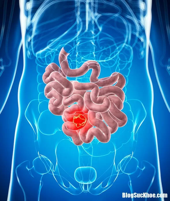 Những triệu chứng ung thư ruột cần lưu ý kẻo nhầm với bệnh khác