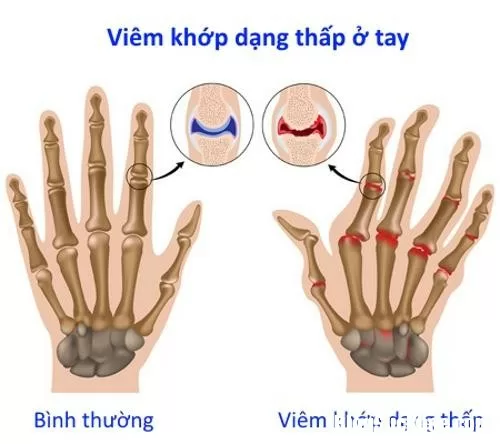 Nguyên nhân và dấu hiệu của viêm khớp dạng thấp