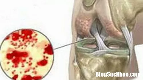 Viêm khớp sinh mủ dễ gây nhiều hậu quả nguy hiểm