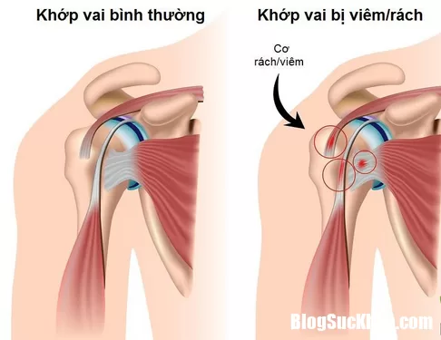 Cần điều trị đúng bệnh viêm quanh khớp vai