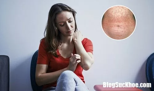 Những tình trạng liên quan tới căn bệnh vẩy nến bạn nên biết