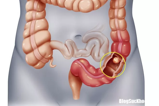 Đau bụng đi ngoài có thể là dấu hiệu sớm của 4 bệnh ung thư