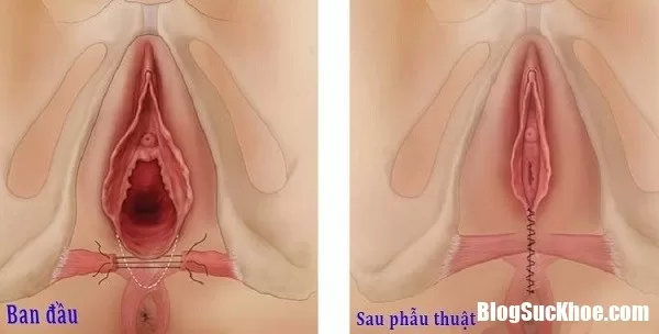 Rạch tầng sinh môn - Các bà mẹ chăm sóc và hồi phục như thế nào?