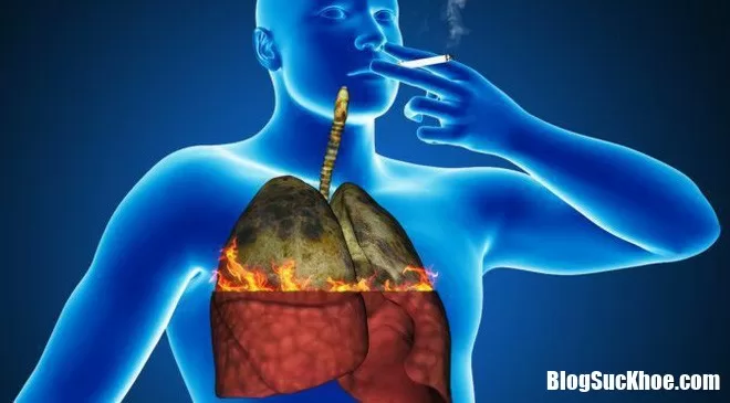 Những dấu hiệu sớm của bệnh ung thư phổi ở nam giới bạn nên cảnh giác
