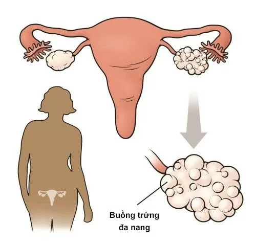 Rối loạn rụng trứng - Một trong những nguy cơ gây vô sinh ở nữ giới