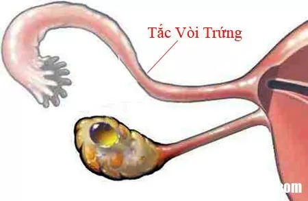 Phụ nữ không nên chủ quan với các bệnh lý ở vòi trứng
