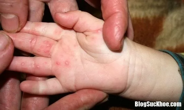 Điều trị tay chân miệng cho trẻ bằng vắc xin