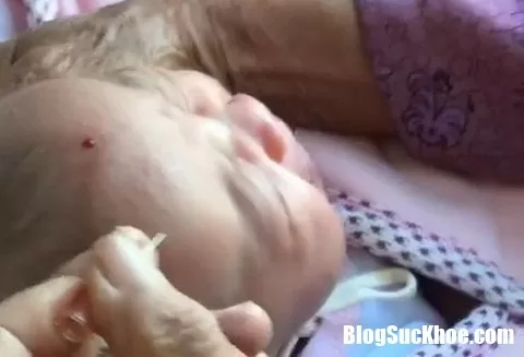 Ngày nay vẫn còn việc lấy kim chích nặn máu độc chữa bệnh cho trẻ con