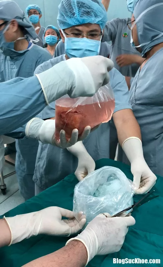 Cảm động chuyện mẹ nuôi và sinh thai nhi vô não để hiến tạng