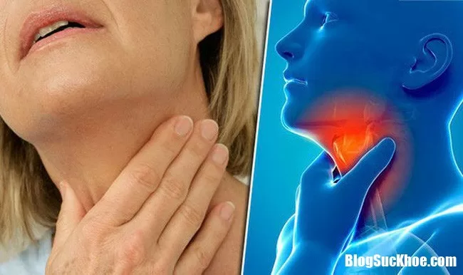 Phòng ngừa ung thu vòm họng không khó, bí quyết ở đây