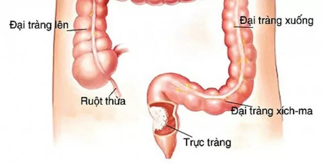 Thói quen ăn uống không lành mạnh là nguyên nhân dẫn đến ung thư ruột
