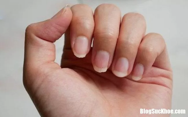 Tình trạng móng tay thay đổi là dấu hệu báo bệnh nguy hiểm