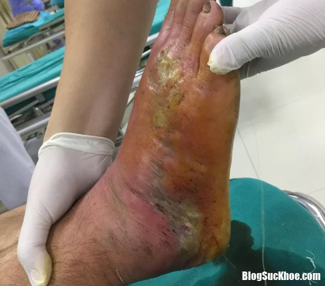 Nhập viện cấp cứu vì tự ý đắp thuốc Nam