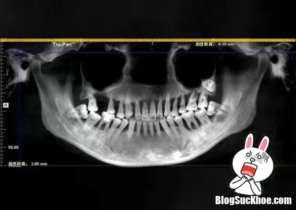 Bệnh nha chu không được chữa trị sớm sẽ gây ra nhiều bệnh nguy hiểm