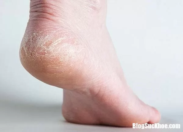 Nứt nẻ gót chân là dấu hiệu ung thư da?