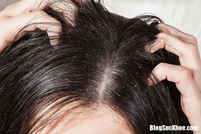 Những thói quen này đang gây hại nghiêm trọng cho da đầu của bạn