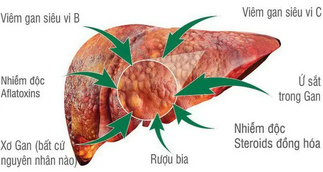 Ung thư gan đang "hoành hành" trên thế giới