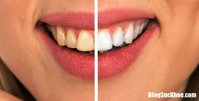 Làm trắng răng và ngừa sâu răng hiệu quả nhờ thói quen sinh hoạt