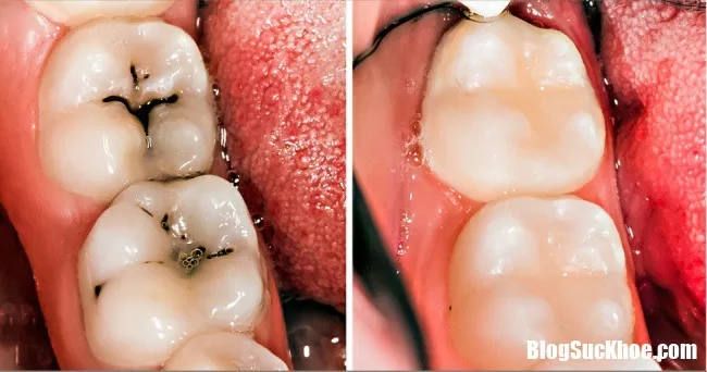 Làm trắng răng và ngừa sâu răng hiệu quả nhờ thói quen sinh hoạt