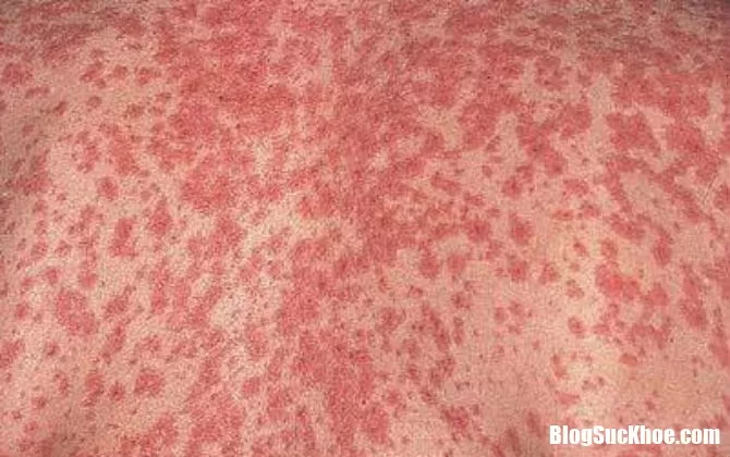 Những điều mọi người nghĩ sai về bệnh sởi gây nên hậu quả đáng tiếc