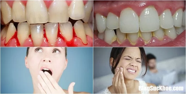 Bệnh nha chu không được chữa trị sớm sẽ gây ra nhiều bệnh nguy hiểm