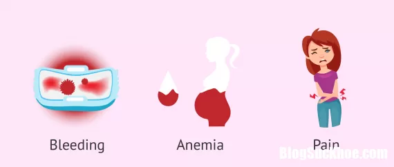 Polyp tử cung là bệnh gì? Ngăn chặn và điều trị như thế nào?