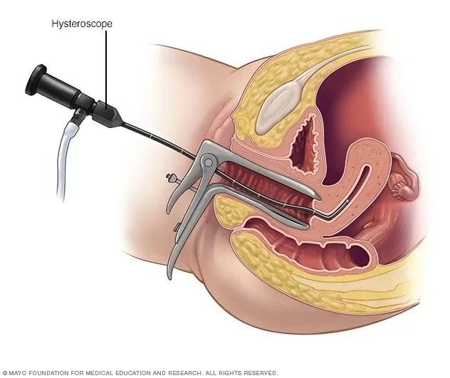 Polyp tử cung là bệnh gì? Ngăn chặn và điều trị như thế nào?