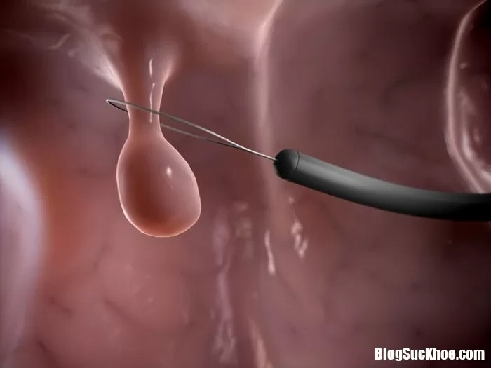 Polyp tử cung là bệnh gì? Ngăn chặn và điều trị như thế nào?
