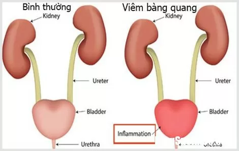 Người lớn tuổi tiểu đêm nhiều lần: Nguyên nhân từ đâu và chữa trị thế nào?