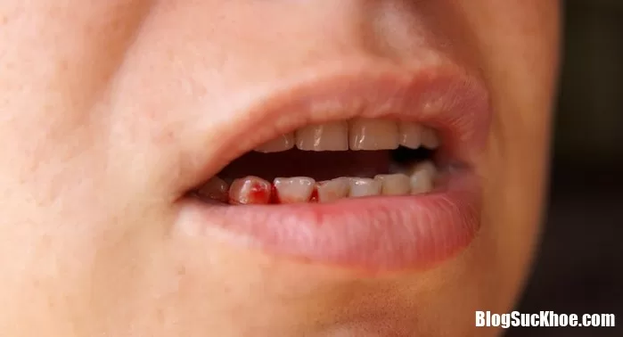 Triệu chứng đột quỵ và nhiều bệnh nguy hiểm xảy ra hàng ngày
