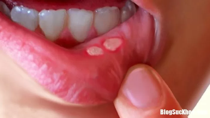 Bài thuốc chữa nhiệt miệng nhanh và phù hợp với nhiều đối tượng