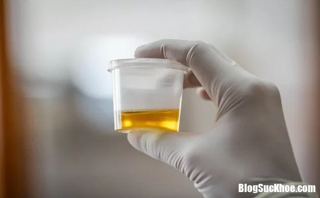 Xuất hiện máu trong nước tiểu là nguyên nhân bệnh gì?