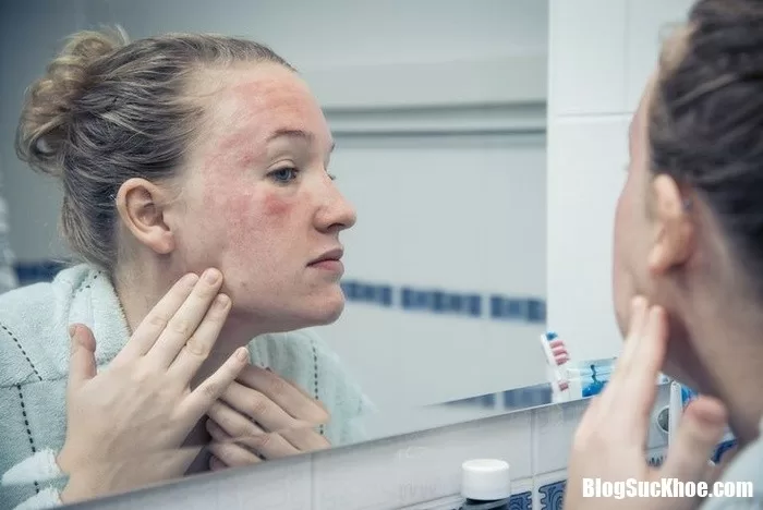 Dị ứng thực phẩm và những suy nghĩ hoàn toàn sai lầm