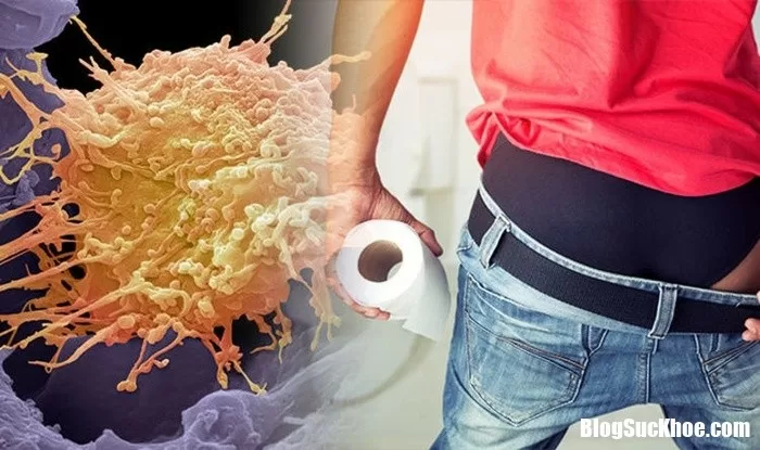 Ung thư hậu môn: Những điều cần biết về nguyên nhân và triệu chứng