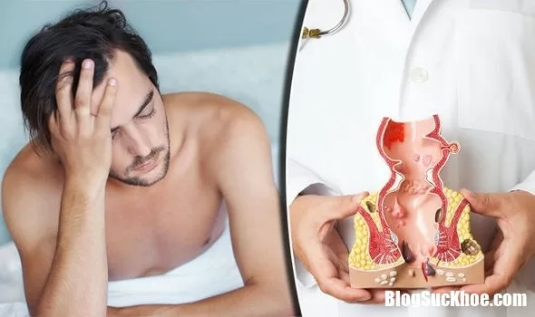 Ung thư hậu môn: Những điều cần biết về nguyên nhân và triệu chứng