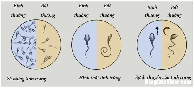 Nguyên nhân khiến tinh trùng bị biến dạng, ảnh hưởng đến sinh sản
