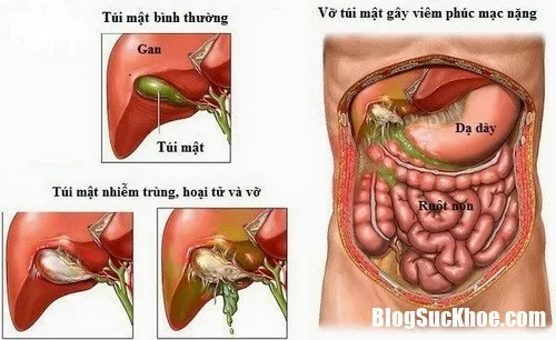 Viêm xơ đường mật có nguy hiểm tới tính mạng?