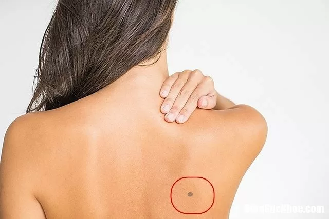 'Sát thủ' ung thư từ nốt ruồi bạn cần phải đề phòng