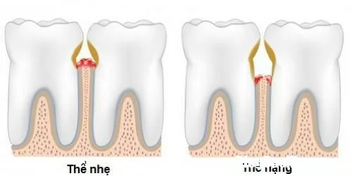 Thường xuyên chảy máu chân răng thì nên biết điều này