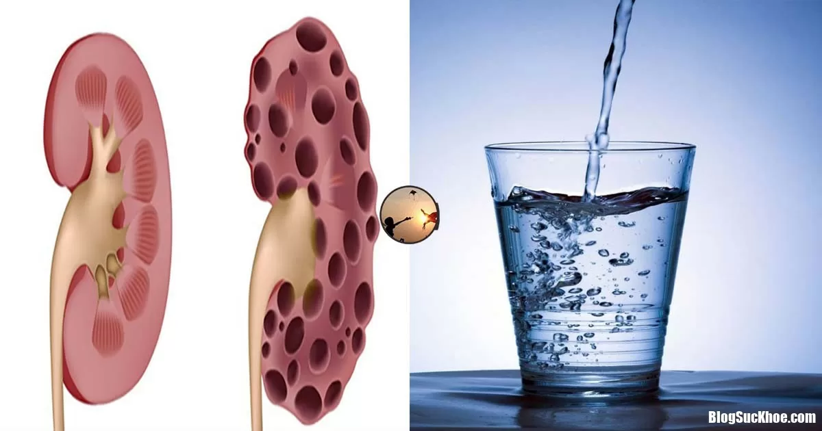 Cách kiểm tra xem có bị bệnh thận hay không: Chỉ vài 1 phút và 1 ly nước sạch mà thôi