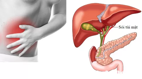 Cắt bỏ túi mật có ảnh hưởng đến vấn đề tiêu hóa?