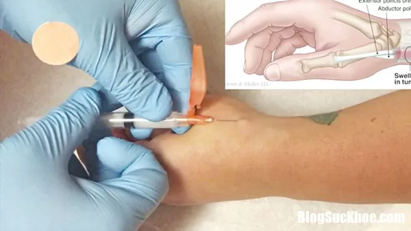 Bí quyết nhận diện tình trạng viêm gân: cấp hay mạn!
