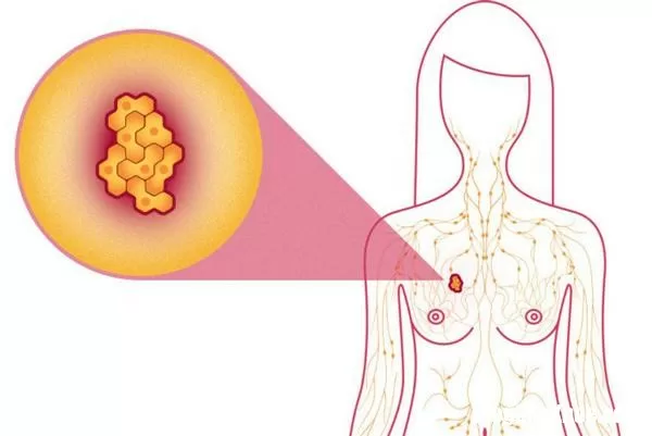 Ung thư vú: Dấu hiệu, nguyên nhân và các giai đoạn phát triển bệnh
